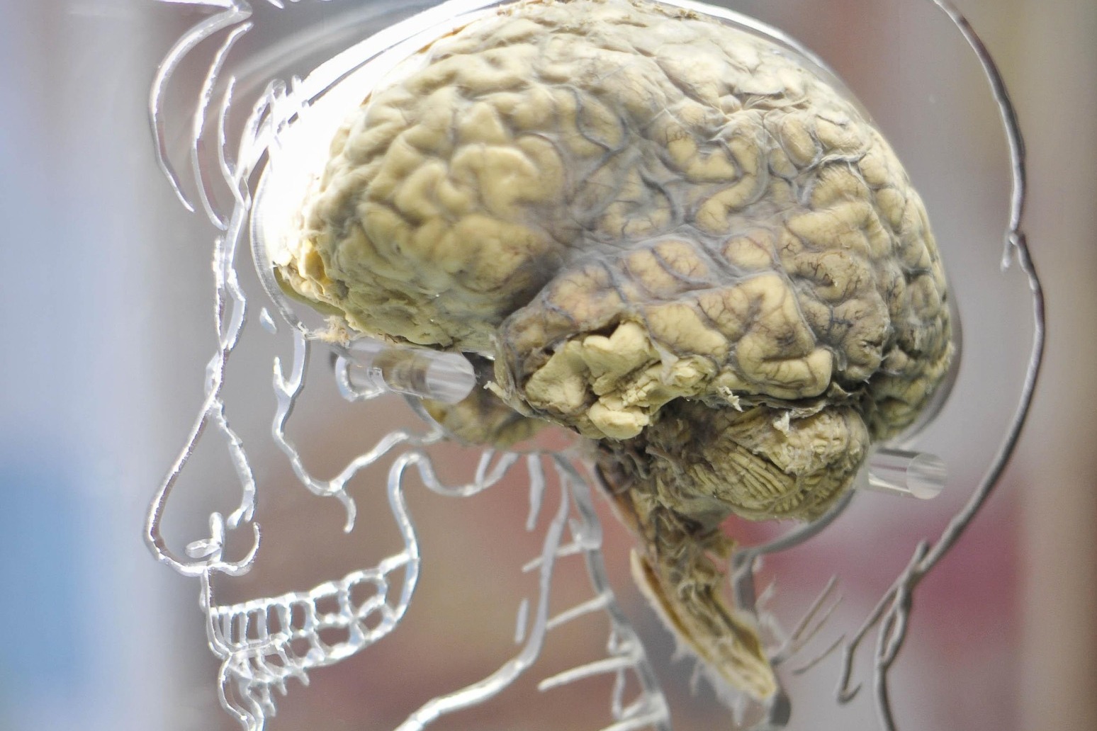 45% of people with concussion show brain injury symptoms six months later 