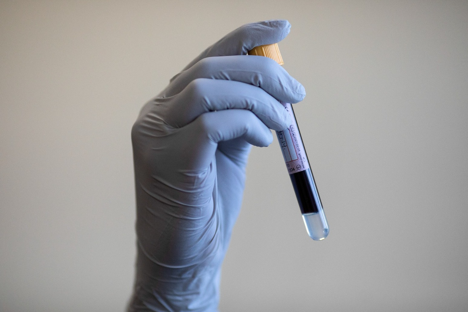 Blood test can predict dementia 