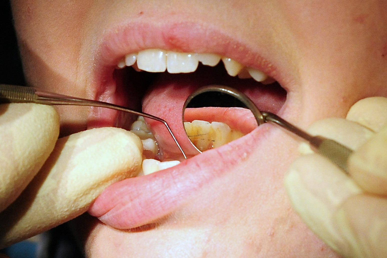 Concerns raised about dental health in deprived areas 